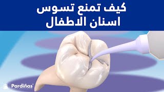 © كيف تمنع تسوس اسنان الاطفال