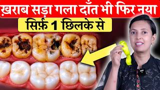 Download Lagu सिर्फ़ 1 छिलके से! कीड़ा लगा, सड़ा, गला और खोखला दाँत फिर से नया | Teeth Cavity