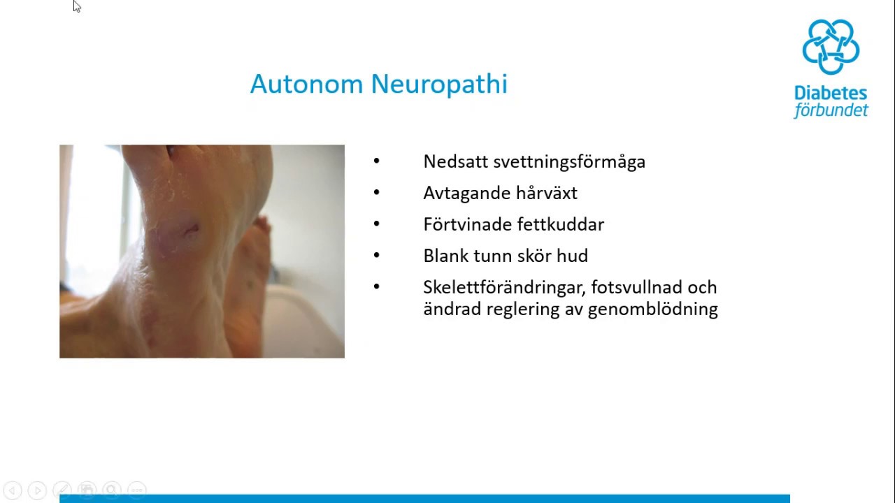 kuddar under fötterna diabetes kuddar under fötterna diabetes