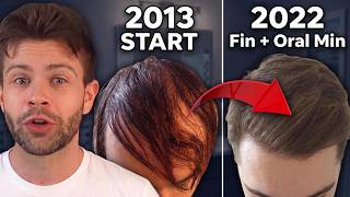 What Happens After 10 Years on Finasteride Minoxidil