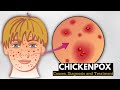 Chickenpox, Causes, Signs and Symptoms, Diagnosis and Treatment.