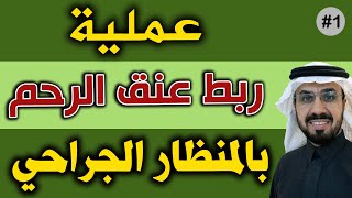عملية ربط عنق الرحم بواسطة المنظار الجراحي عملية ربط عنق الرحم بواسطة المنظار الجراحي