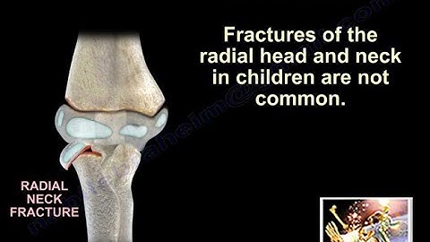 Radial Head & Neck Fractures In Children - Everything You Need To Know - Dr. Nabil Ebraheim