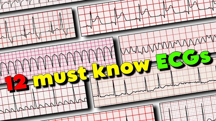 ECG Rhythms every Medical Professional must know! 🚀
