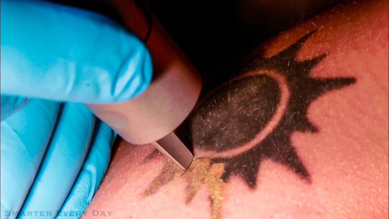 How Laser Tattoo Removal Works - Smarter Every Day 123 - YouTube