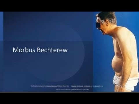 Video: Wann beginnt Morbus Bechterew?