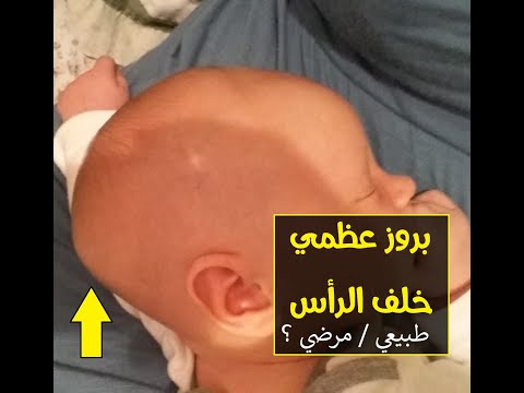 بروز عظمي خلف الراس