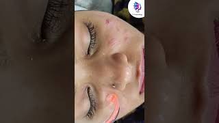 Get Rid of Stubborn Acne by Acne Treatment | VJ’s Cosmetology Clinic