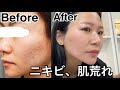 肌荒れが治った方法を教えます!