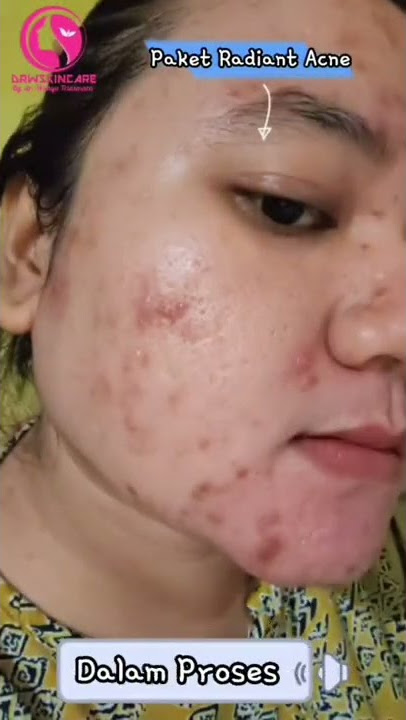Kulit bebas jerawat bukan hal yang mustahil lagi! Dengan Radiant Acne by DRW Skincare