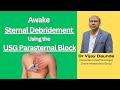 Awake Sternal Debridement Using Ultrasound Guided Parasternal Block I Dr Vijay Daunde
