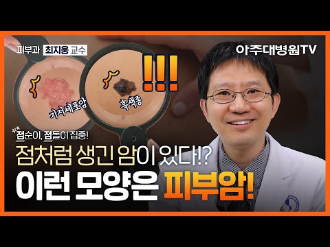 점 VS 피부암🔥 &rsquo;이런 점&rsquo;이 피부암입니다😱 피부암의 종류부터 원인, 예방법까지!! 피부과 최지웅 교수 [아주대병원TV]