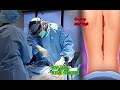 Asmr backbone surgery -Lumbar Surgery Animation | Spinal Cord Surgery Animation