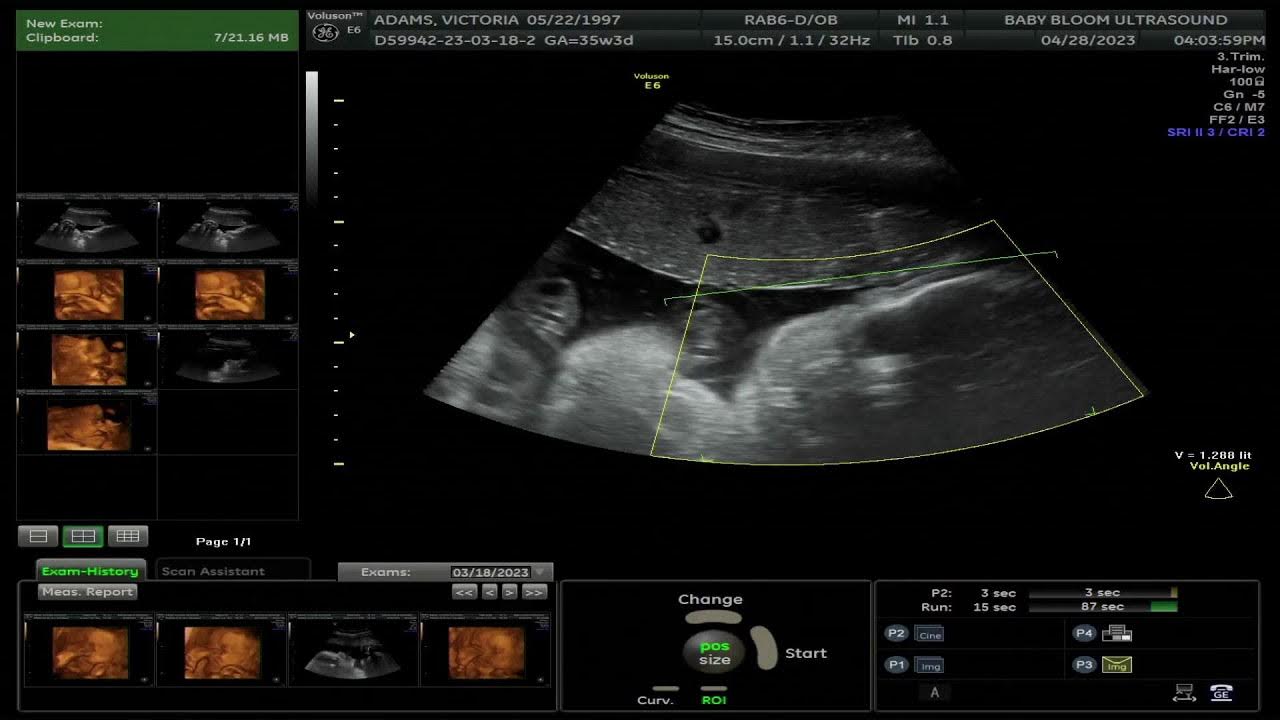 Baby bloom ultrasound live stream youtube