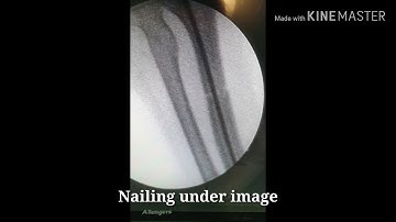 Titanium Elastic Nailing for Forearm Fractures | Diaphyseal Fixation (Orthopedic Surgery)