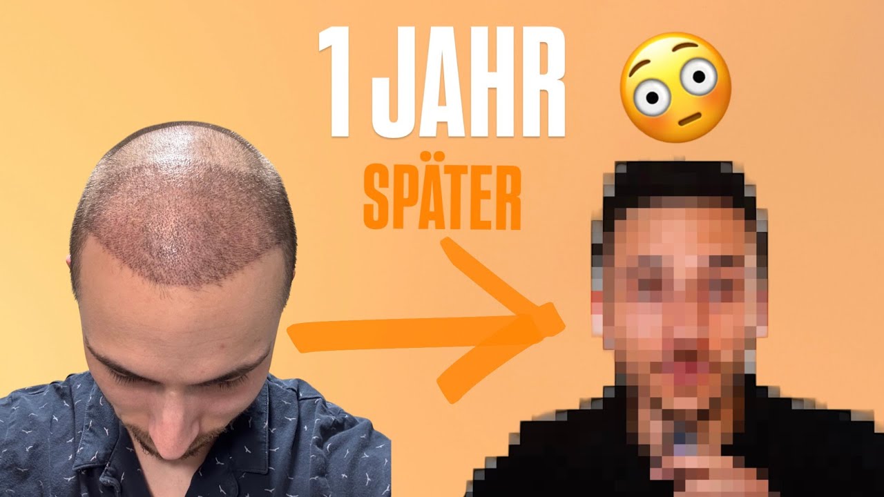HAARTRANSPLANTATION: Würde ich es nochmal tun? Die ehrliche Wahrheit nach 1 Jahr! 😳💆🏼‍♀️