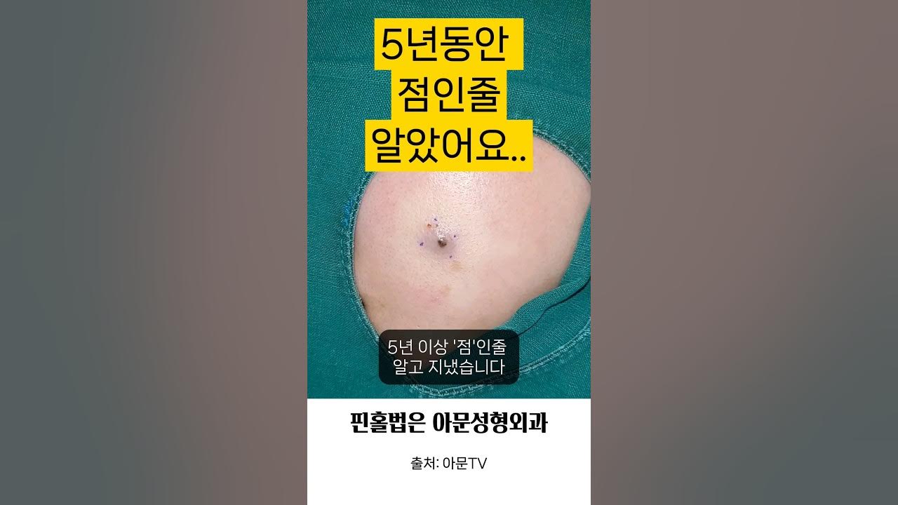 5년이상 점인줄 알았어요 (핀홀법 수술 피지낭종 표피낭종 피부과 성형외과 병원 흉터 Epidermal Cyst Surgery ...