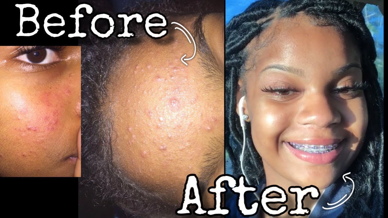 HOW I CLEARED MY ACNE WITH ONLY 2 AFFORDABLE PRODUCTS ( Pictures ...