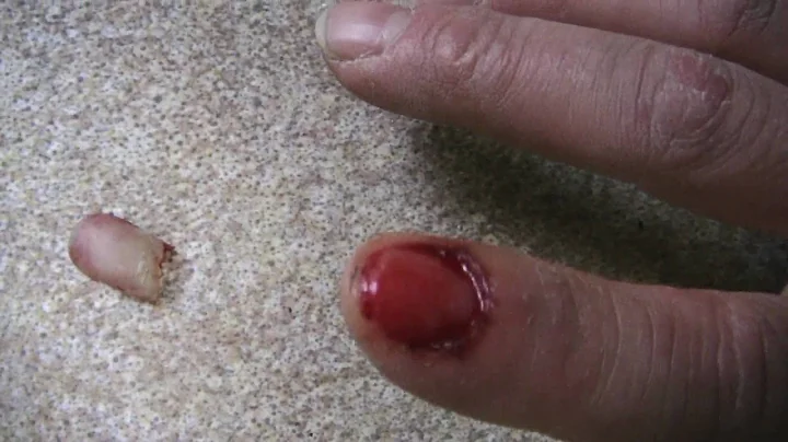 ripping my fingernail completely off
