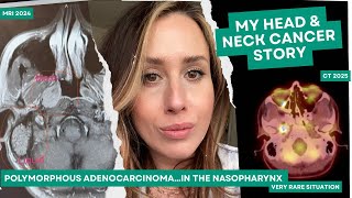 Polymorphous Adenocarcinoma in nasopharynx my rare cancer story minor salivary gland cancer at 39