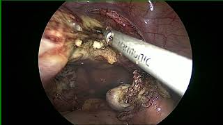 TOTAL LAPAROSCOPIC HYSTRECTOMY with ultrasonic scalpel