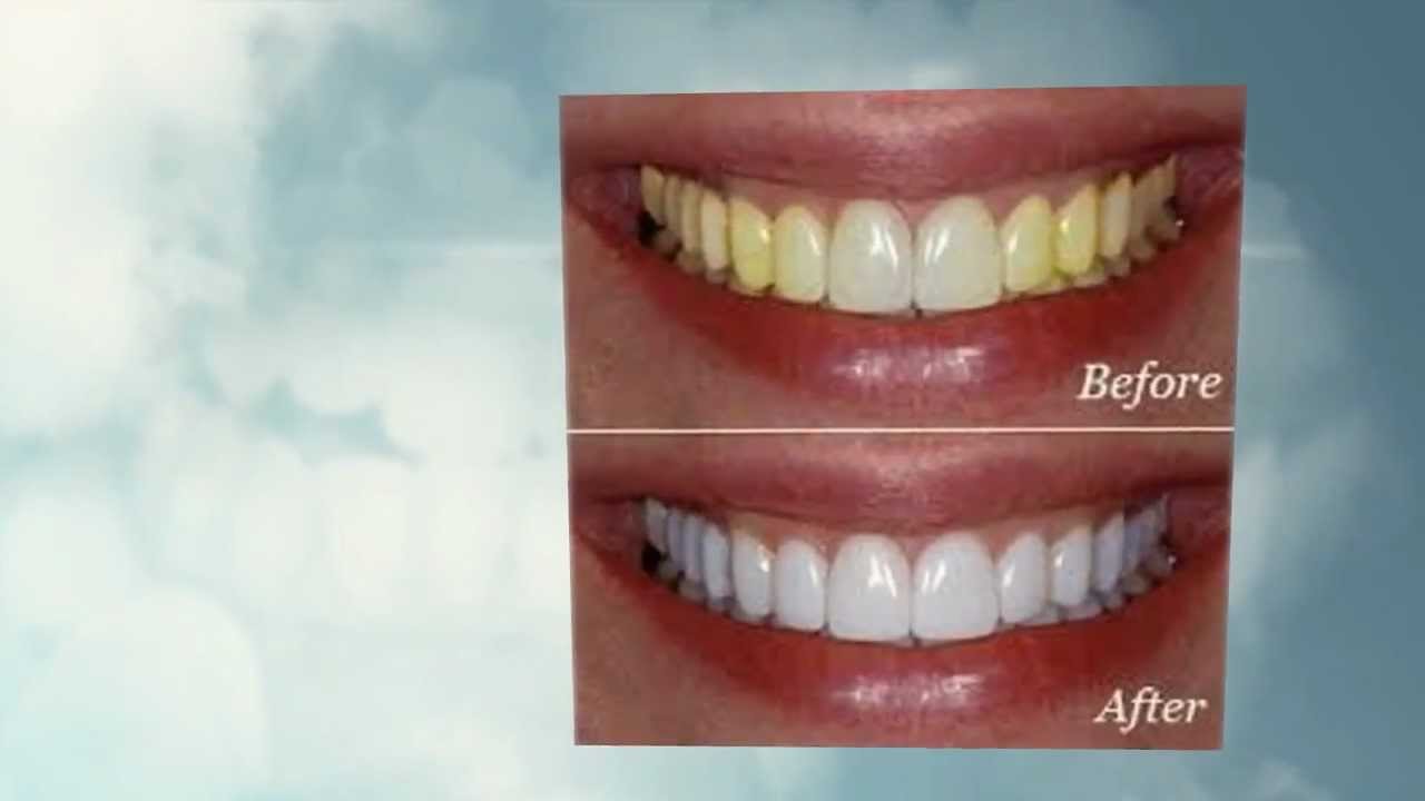 Tooth Whitening Dentist Decatur, AL Dr. Stephanie Teichmiller 256