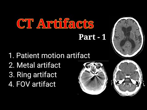 Video: Ce este artefactul la scanarea CT?