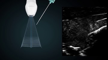 Onvision® - Needle Guidance for PNB with Xperius