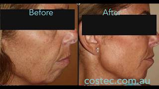 HIFU™ treatment - Before & After pictures for Face Lift and Skin Tightening