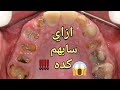خلع الاسنان التالفه بقايا الضروس 