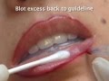Lip Liner Embroidery Procedure with Paramedic Aesthetics & Biotouch