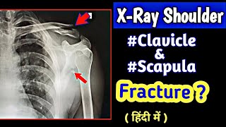 How to read shoulder Fracture Xray | Fracture clavicle | Fracture scapula | UdayXray