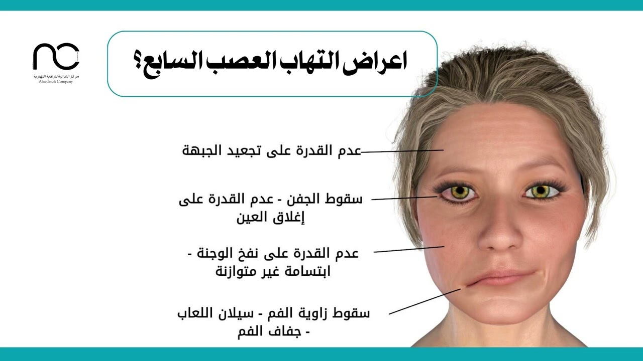 ورشة عمل بعنوان ( التهاب العصب السابع)
