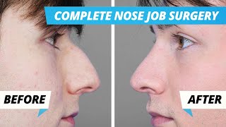 Nose Job Surgery - Pre-Op, Full Surgery, 1 Week Post Op, 8 Week Post Op