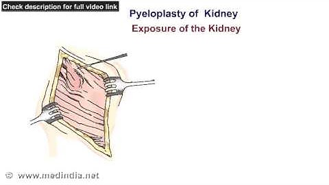 Pyeloplasty Of Kidney