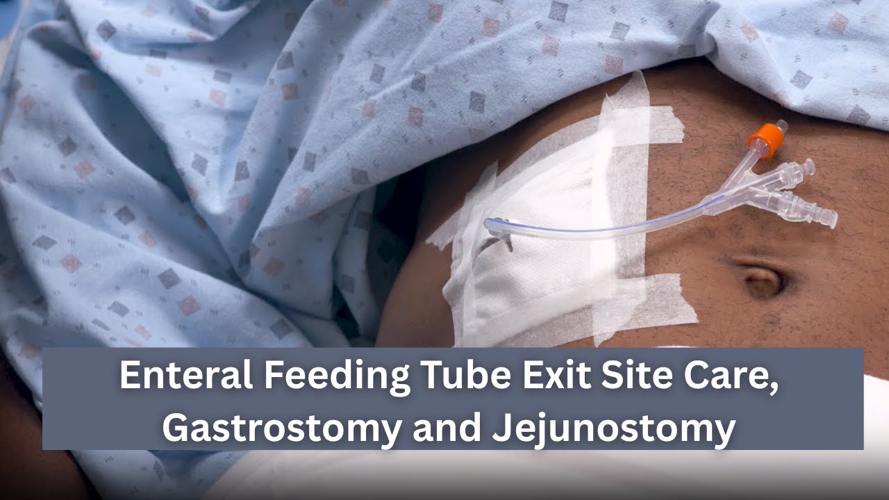 Enteral Feeding Tube Exit Site Care, Gastrostomy and Jejunostomy