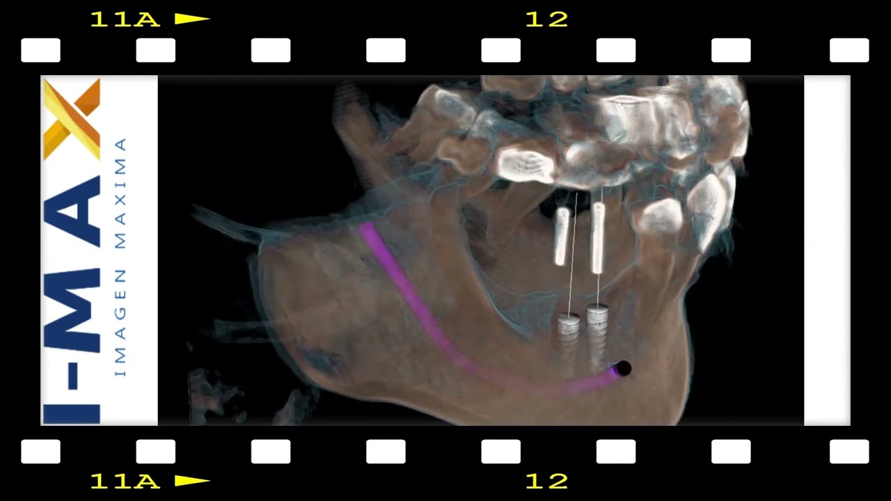 PLANIFICACION DE IMPLANTES CON GUIA QUIRURGICA