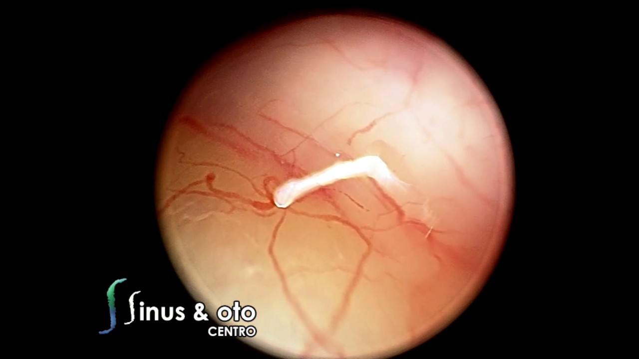 Endoscopic stapes surgery YouTube