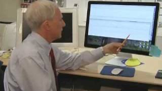 Gene Mutation Associated with Type 2 Diabetes in U.S. and European Patients