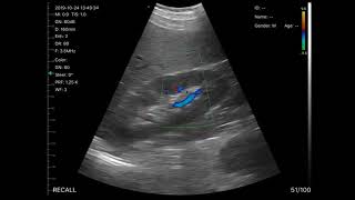 Vsono-CL3 Long Axis Kidney  Convex Phase