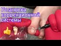 Установка коррекционной системы 🦶🏻👌