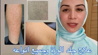 انواع وعلاج جلد الوزة strawberry skin | فاطمة انور