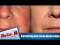 Капиллярная мальформация. “Доктор И“