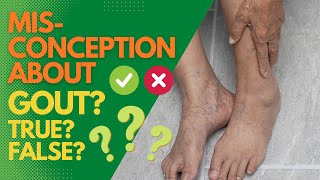 Misconceptions About Gout True? False?