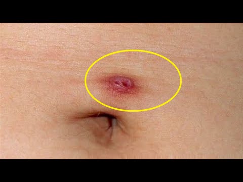 how to get rid of a belly button piercing scar
