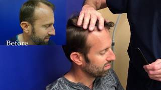 3522 Grafts after 1 Year - Great life changing results!