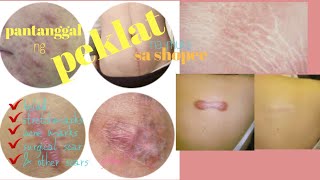 PANTANGGAL NG PEKLAT NA MURA SA SHOPEE||PWEDE SA KELOID, STRETCHMARKS,ACNE & OTHER SCARS|Ms Sungit