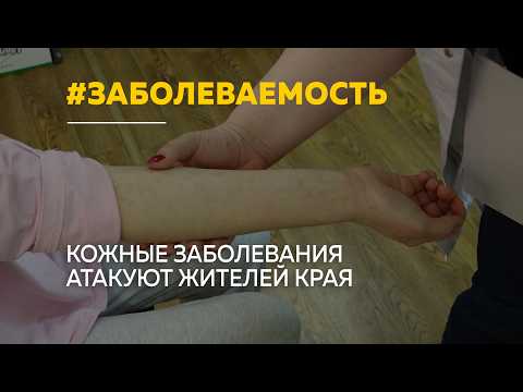 Палаты переполнены в Алтайском крае растет заболеваемость кожными болезнями