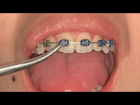 Video: Cara Memilih Warna Kawat Gigi Anda: 14 Langkah (dengan Gambar)