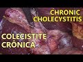 Cholecystectomy  chronic cholecystitis  full60fps